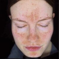 How do I treat my Melasma?