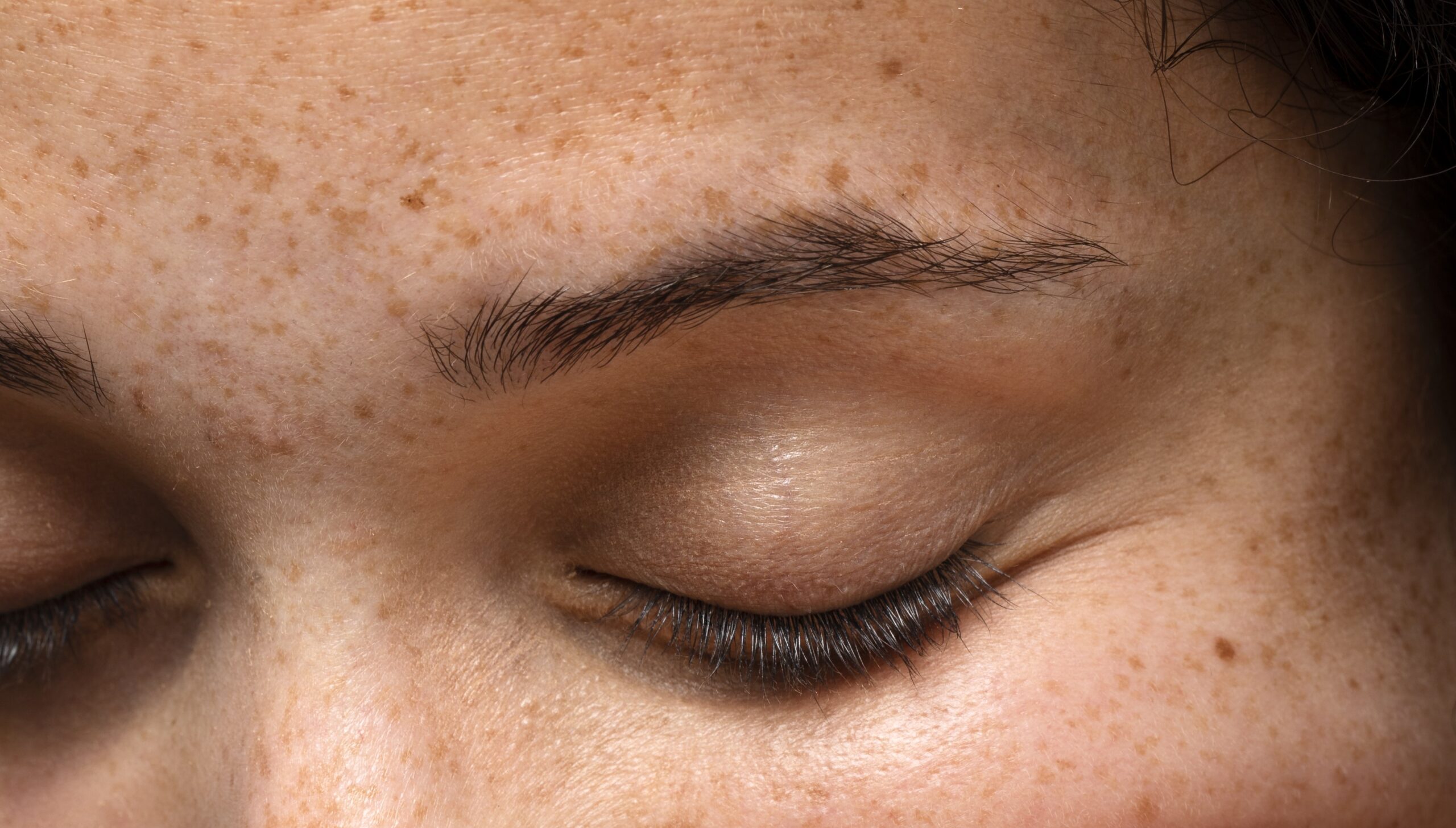How do i treat sunspots