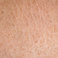 Understanding Dryness and Dehydration: Causes, Symptoms, and Treatments