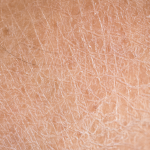 Understanding Dryness and Dehydration: Causes, Symptoms, and Treatments